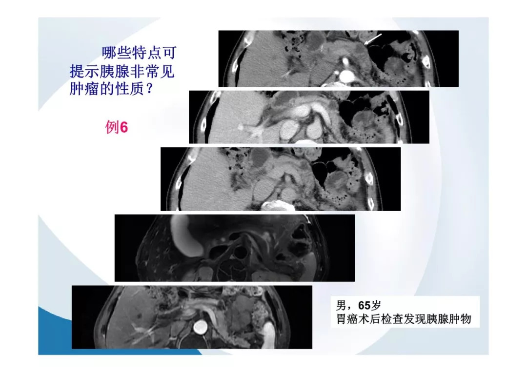 【PPT】胰腺非常见肿瘤影像学检查与诊断思路