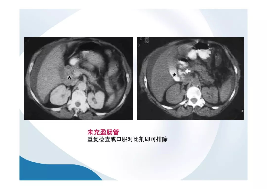 【PPT】胰腺非常见肿瘤影像学检查与诊断思路