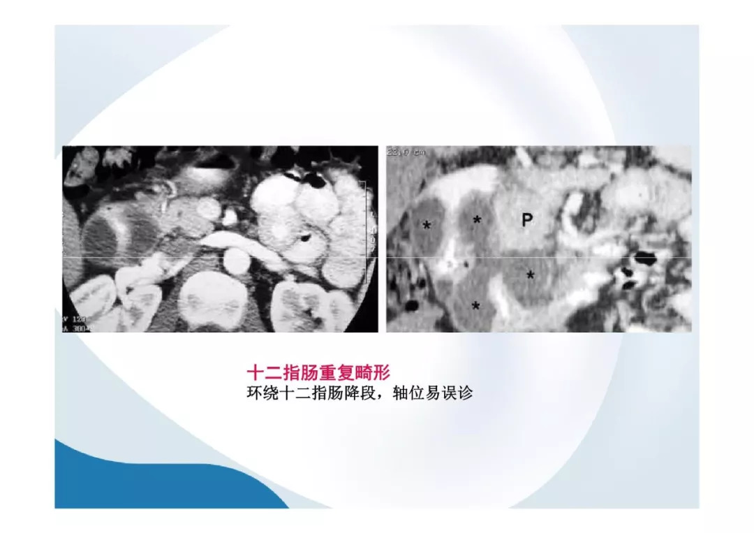 【PPT】胰腺非常见肿瘤影像学检查与诊断思路