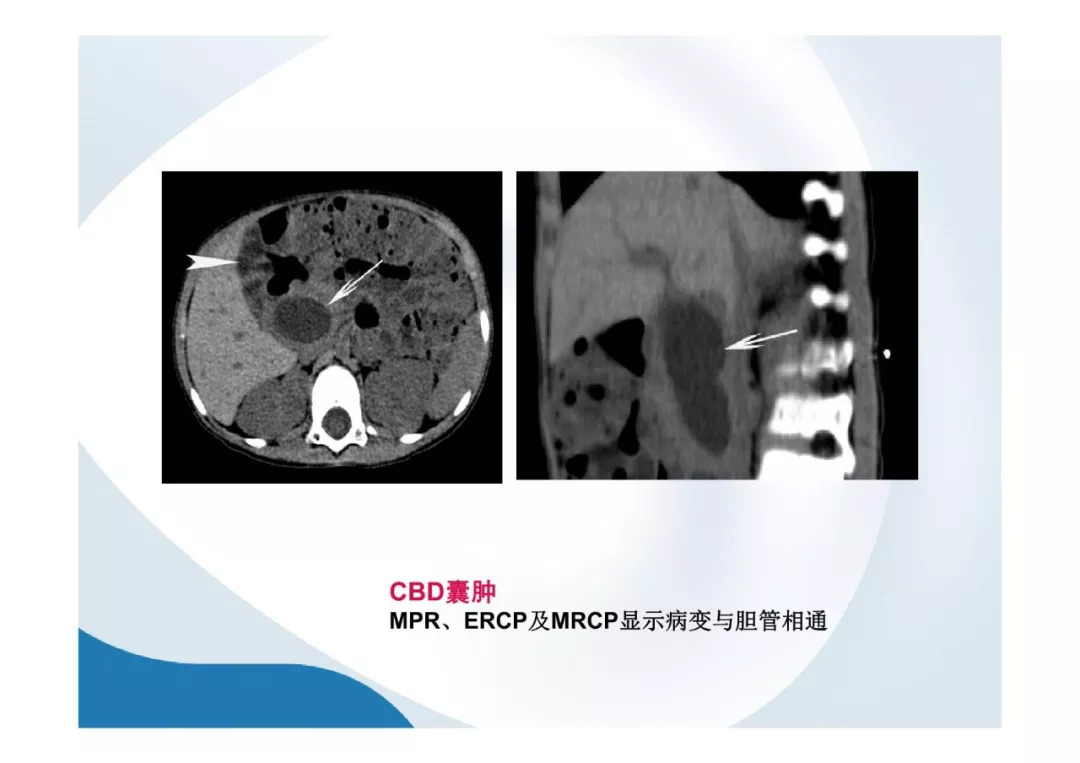 【PPT】胰腺非常见肿瘤影像学检查与诊断思路