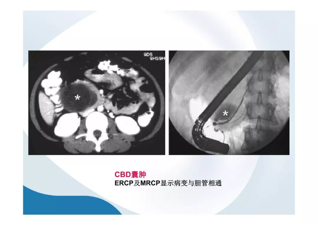 【PPT】胰腺非常见肿瘤影像学检查与诊断思路