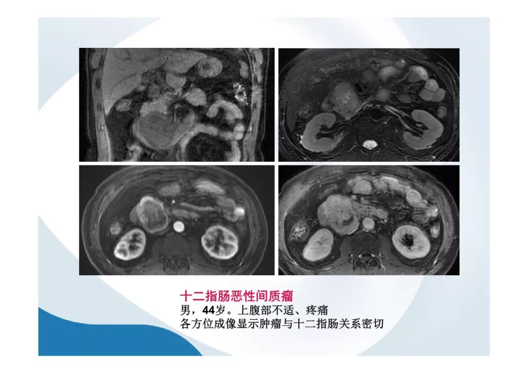 【PPT】胰腺非常见肿瘤影像学检查与诊断思路