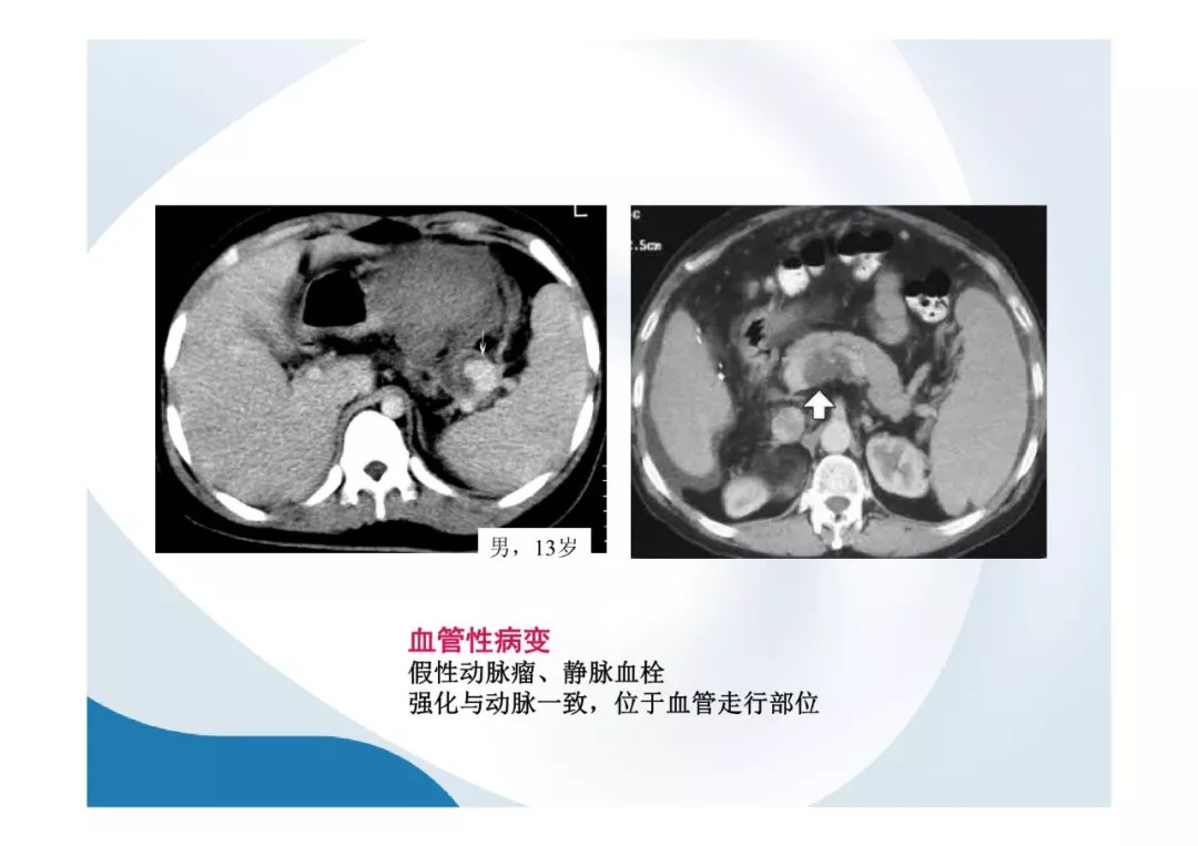 【PPT】胰腺非常见肿瘤影像学检查与诊断思路