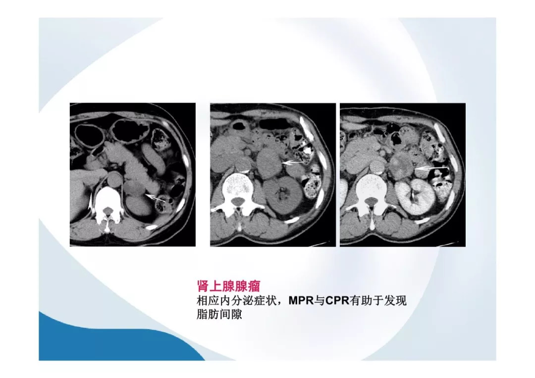 【PPT】胰腺非常见肿瘤影像学检查与诊断思路
