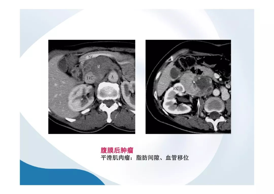 【PPT】胰腺非常见肿瘤影像学检查与诊断思路