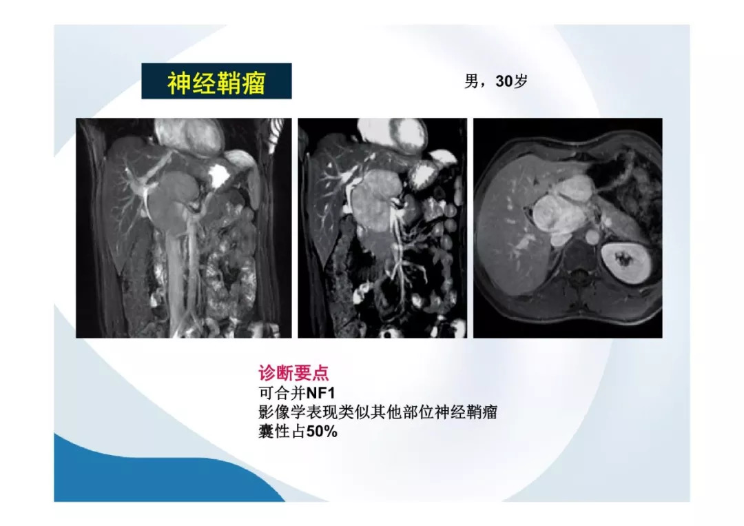 【PPT】胰腺非常见肿瘤影像学检查与诊断思路