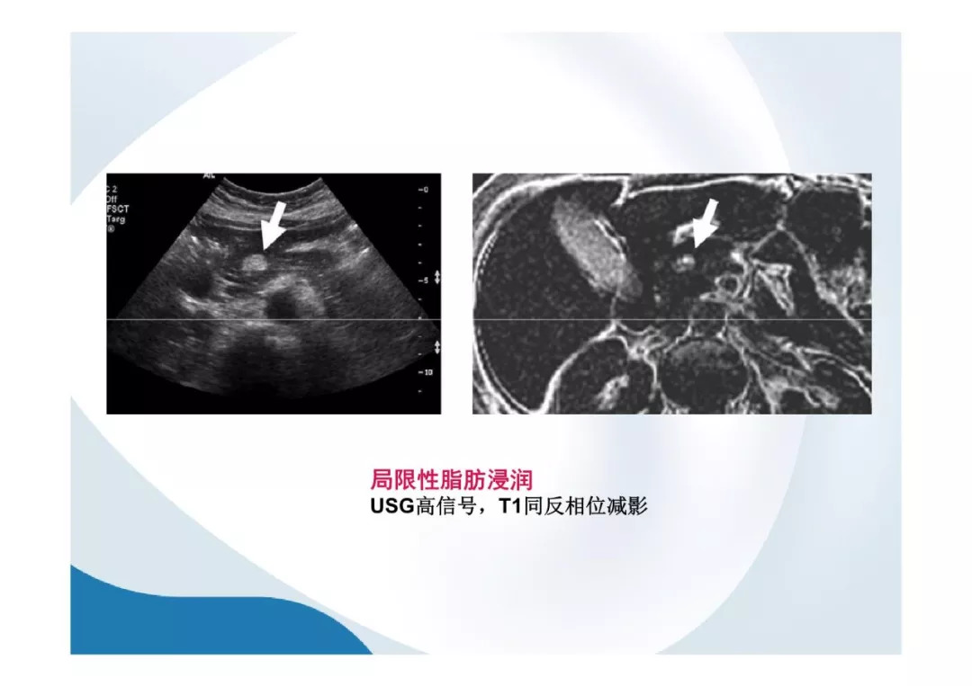 【PPT】胰腺非常见肿瘤影像学检查与诊断思路
