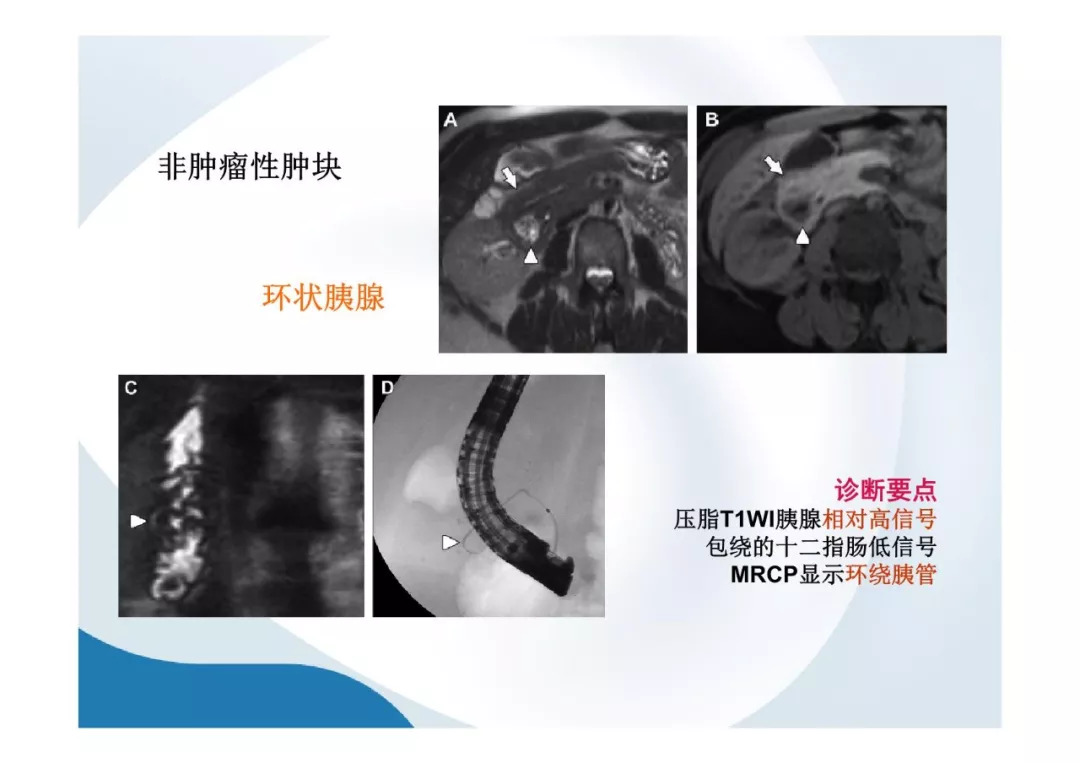 【PPT】胰腺非常见肿瘤影像学检查与诊断思路