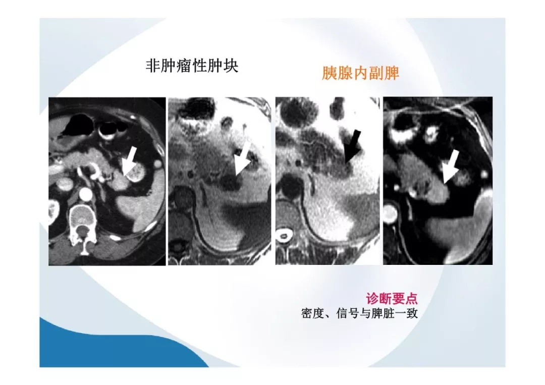 【PPT】胰腺非常见肿瘤影像学检查与诊断思路