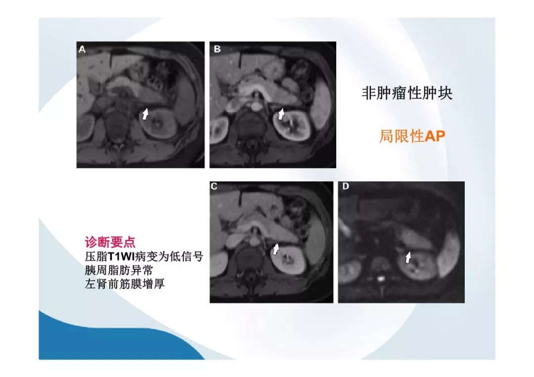 【PPT】胰腺非常见肿瘤影像学检查与诊断思路