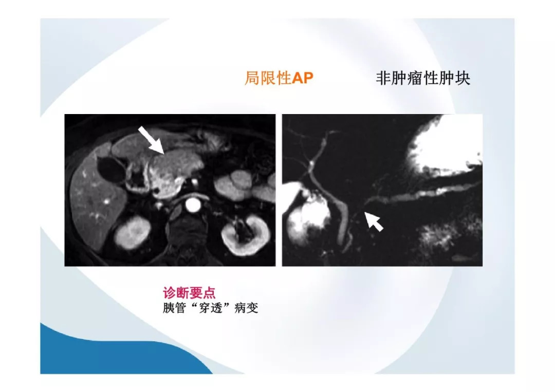 【PPT】胰腺非常见肿瘤影像学检查与诊断思路