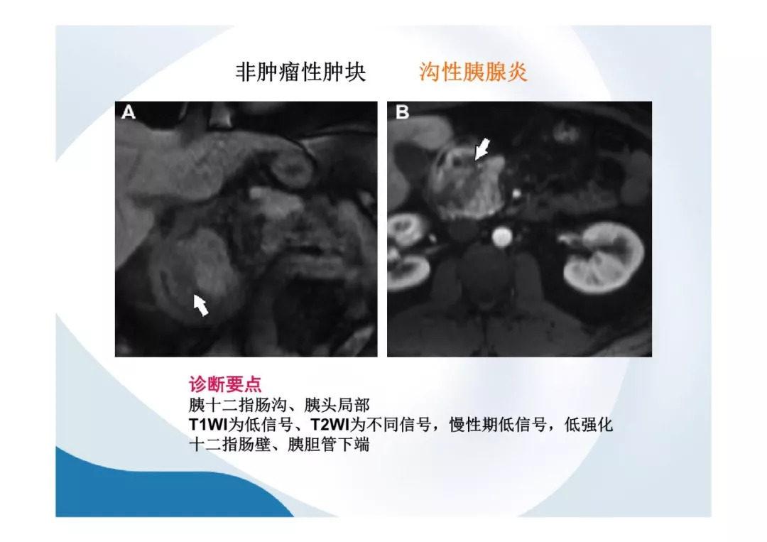 【PPT】胰腺非常见肿瘤影像学检查与诊断思路