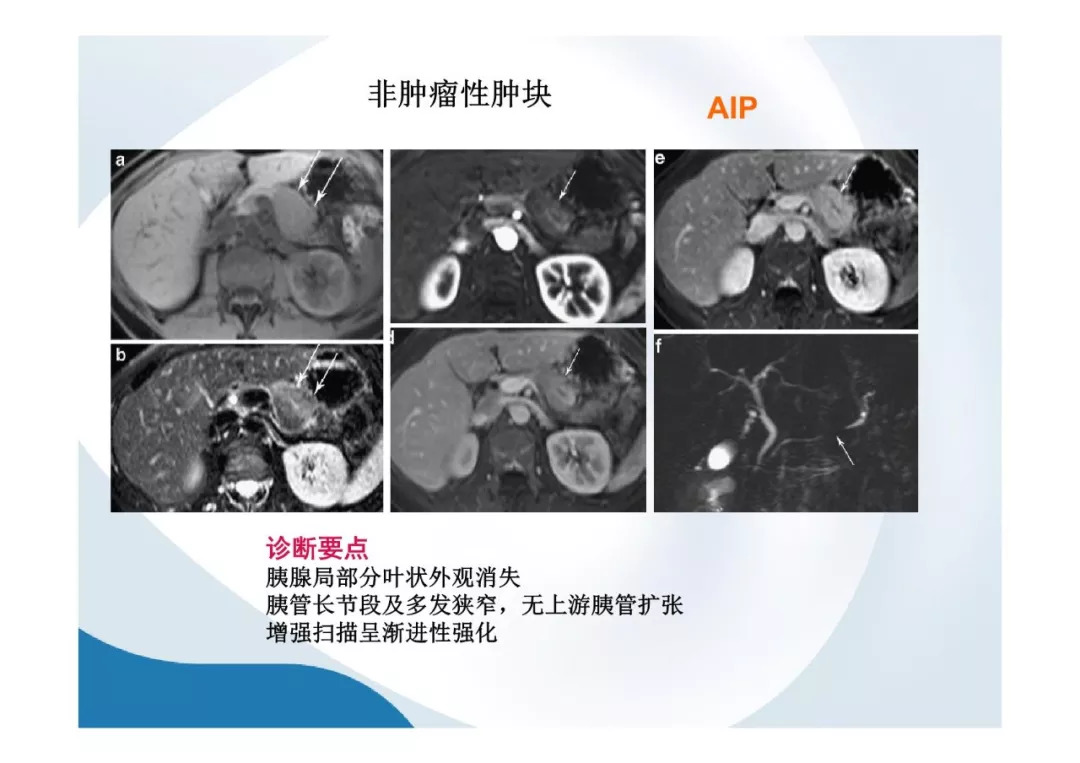 【PPT】胰腺非常见肿瘤影像学检查与诊断思路