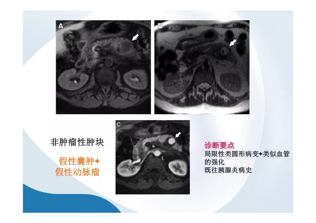 【PPT】胰腺非常见肿瘤影像学检查与诊断思路