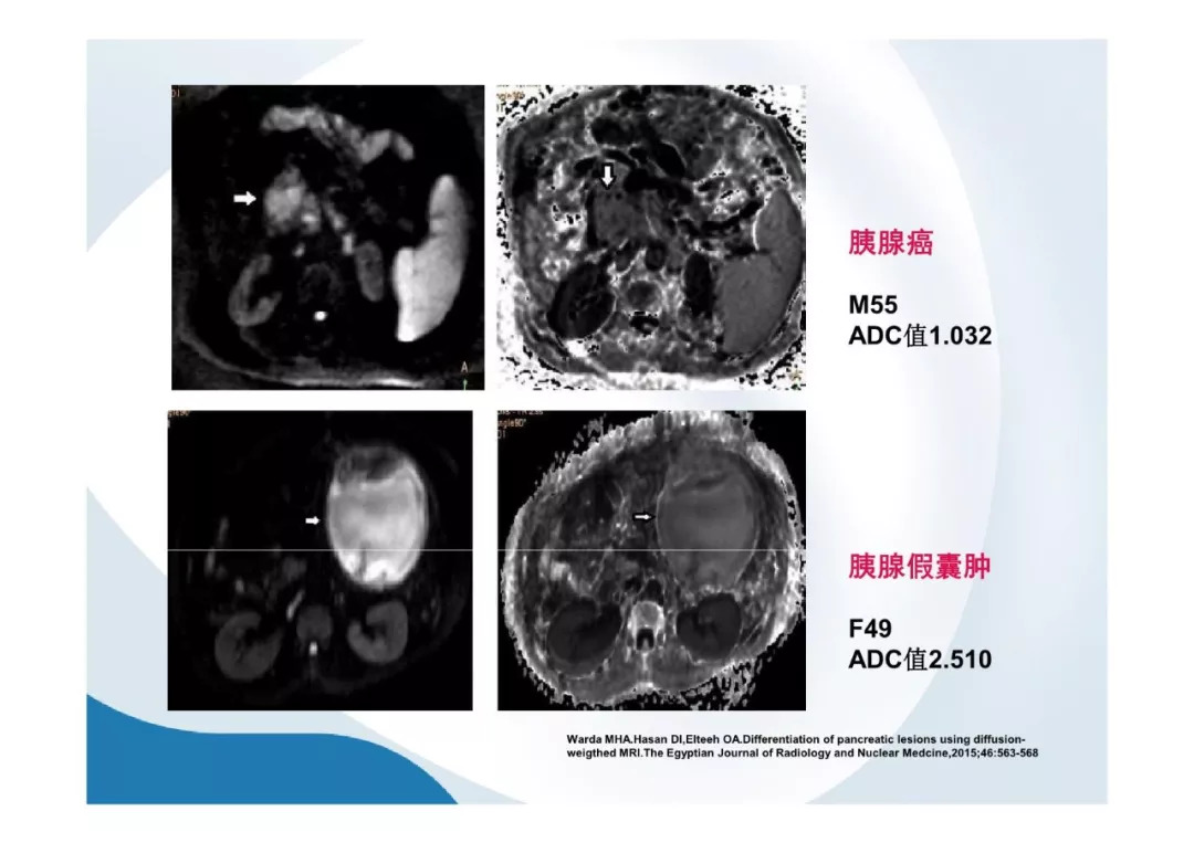 【PPT】胰腺非常见肿瘤影像学检查与诊断思路