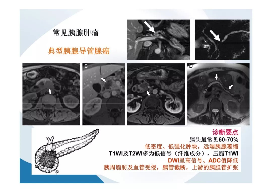 【PPT】胰腺非常见肿瘤影像学检查与诊断思路
