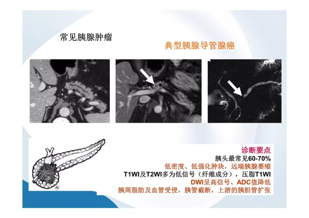 【PPT】胰腺非常见肿瘤影像学检查与诊断思路