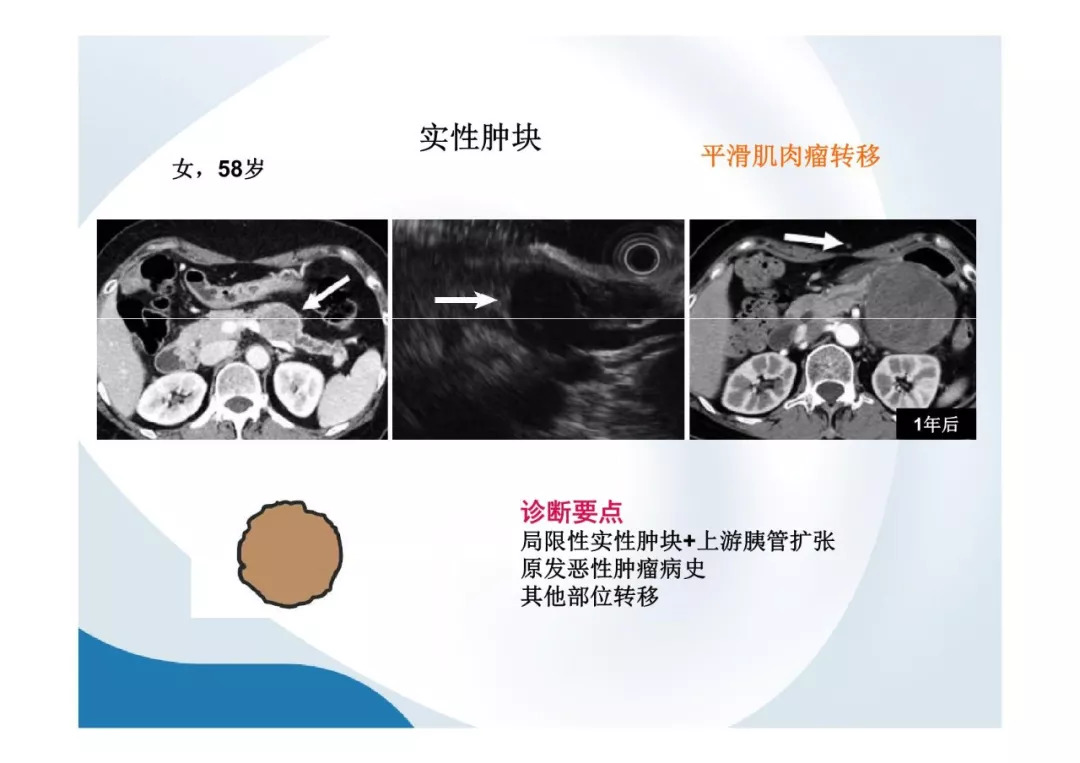 【PPT】胰腺非常见肿瘤影像学检查与诊断思路