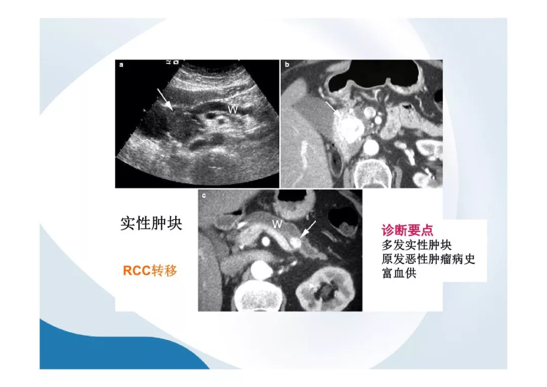 【PPT】胰腺非常见肿瘤影像学检查与诊断思路