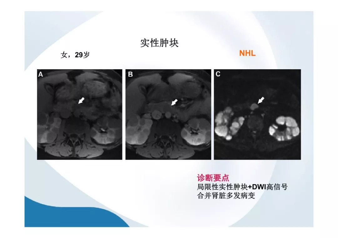 【PPT】胰腺非常见肿瘤影像学检查与诊断思路