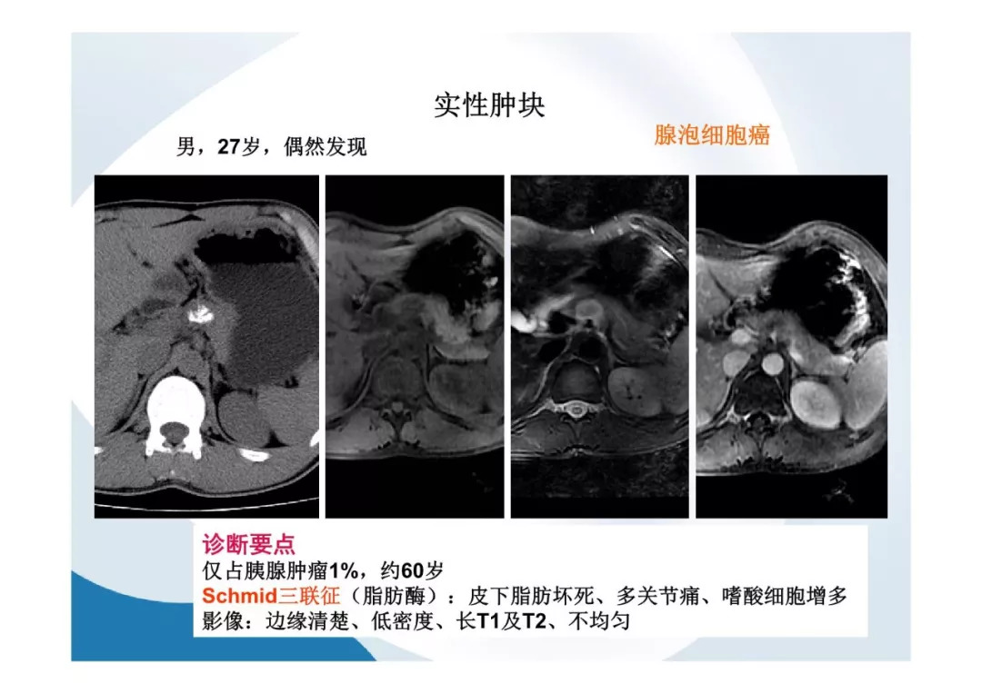 【PPT】胰腺非常见肿瘤影像学检查与诊断思路