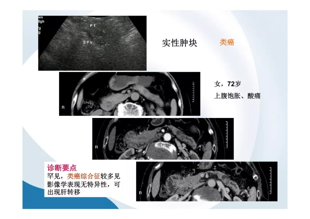 【PPT】胰腺非常见肿瘤影像学检查与诊断思路