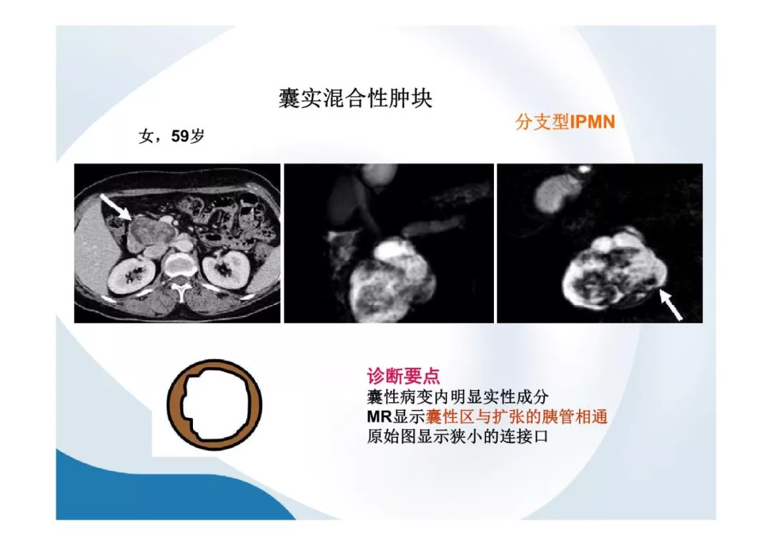 【PPT】胰腺非常见肿瘤影像学检查与诊断思路