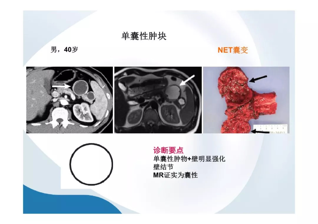 【PPT】胰腺非常见肿瘤影像学检查与诊断思路