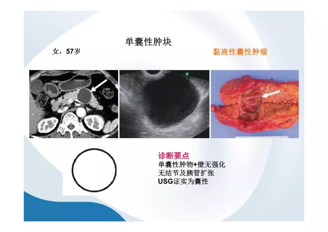 【PPT】胰腺非常见肿瘤影像学检查与诊断思路