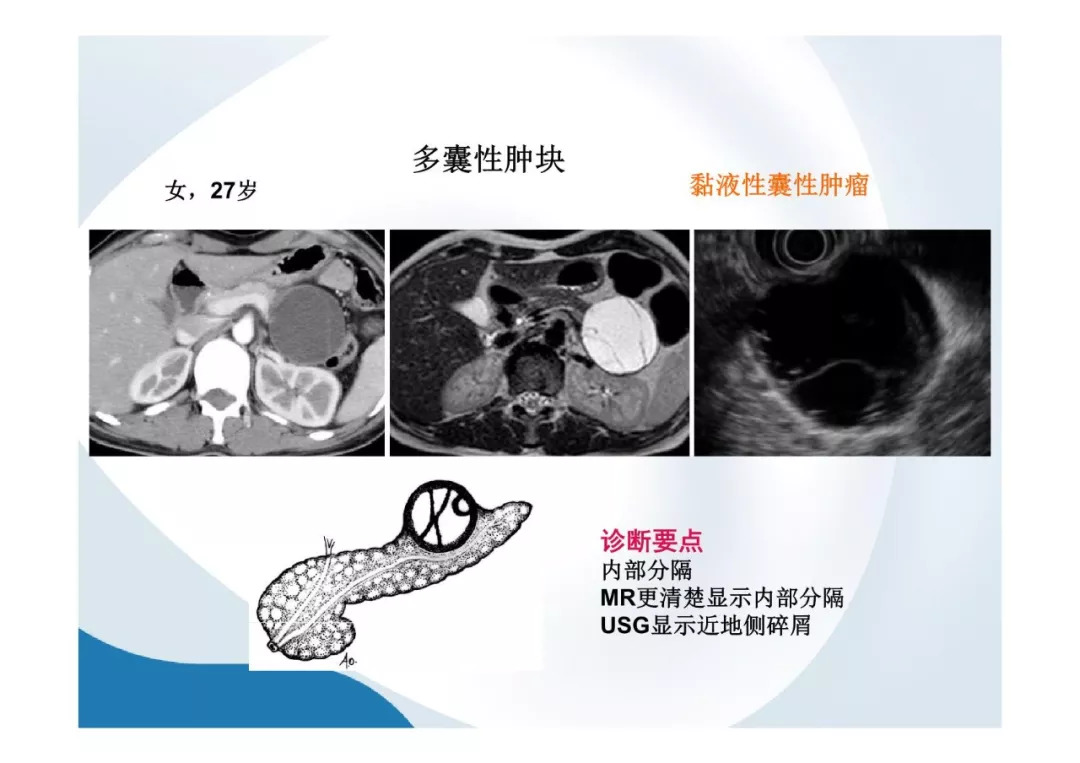【PPT】胰腺非常见肿瘤影像学检查与诊断思路