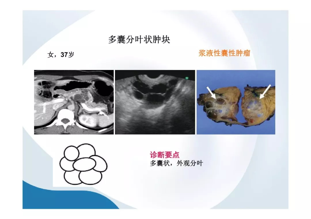 【PPT】胰腺非常见肿瘤影像学检查与诊断思路