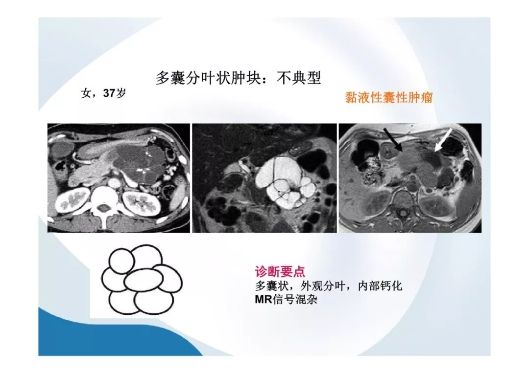 【PPT】胰腺非常见肿瘤影像学检查与诊断思路