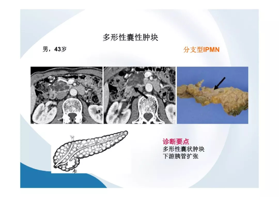 【PPT】胰腺非常见肿瘤影像学检查与诊断思路