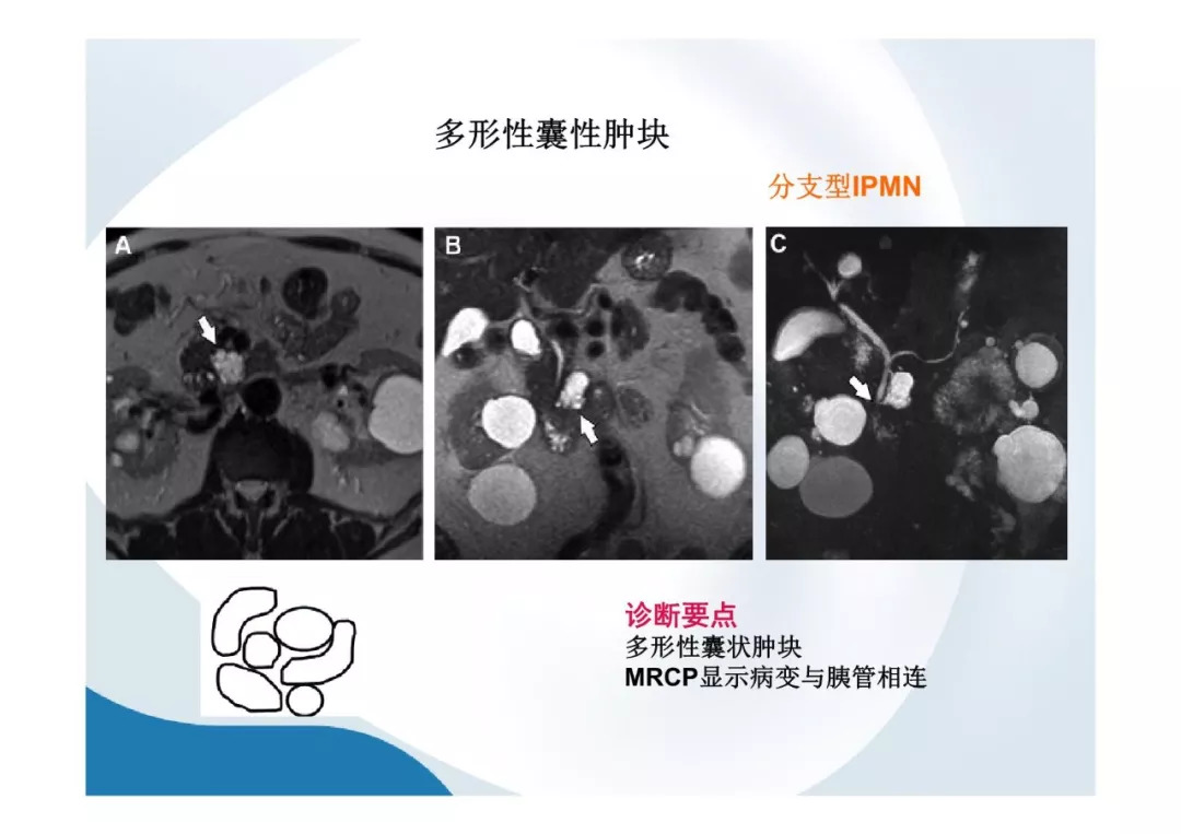 【PPT】胰腺非常见肿瘤影像学检查与诊断思路