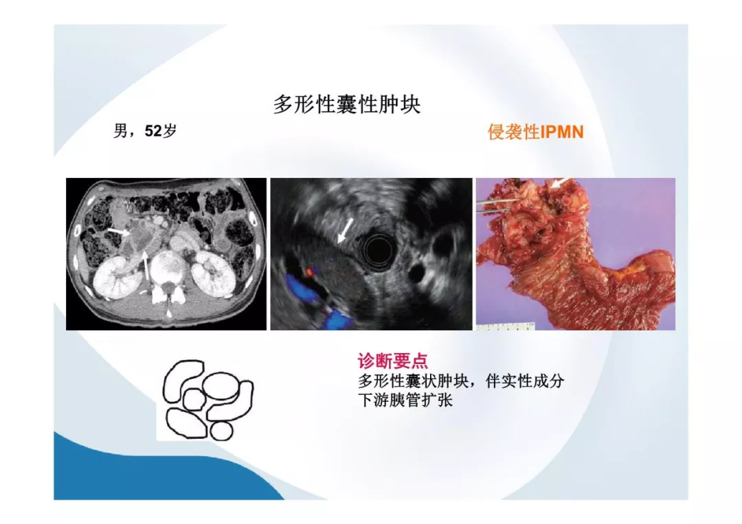 【PPT】胰腺非常见肿瘤影像学检查与诊断思路