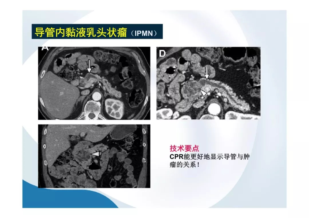 【PPT】胰腺非常见肿瘤影像学检查与诊断思路