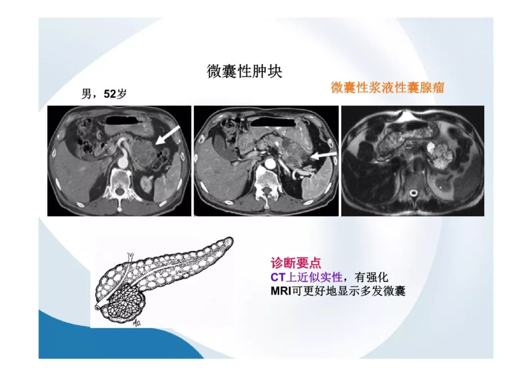 【PPT】胰腺非常见肿瘤影像学检查与诊断思路