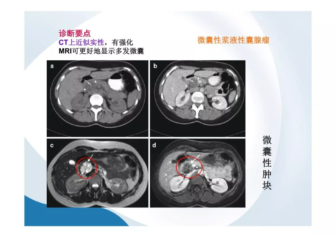 【PPT】胰腺非常见肿瘤影像学检查与诊断思路