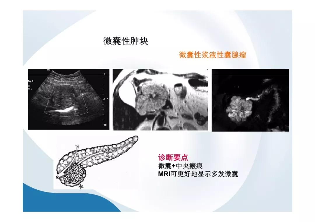 【PPT】胰腺非常见肿瘤影像学检查与诊断思路