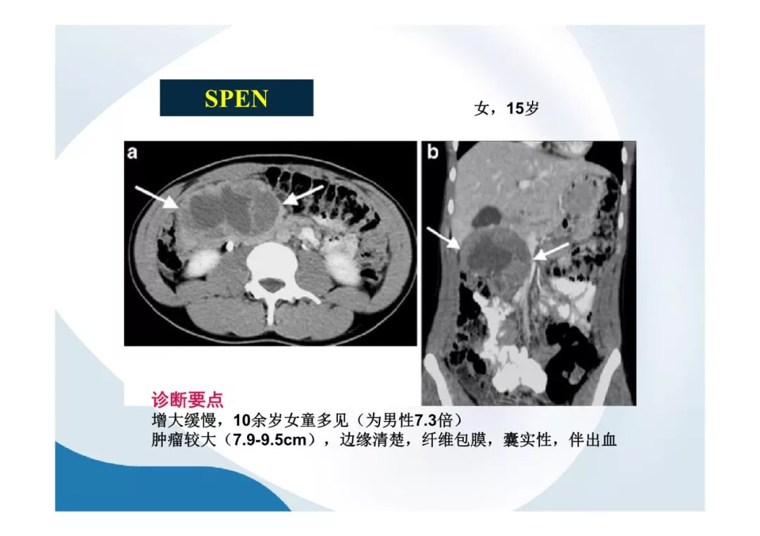 【PPT】胰腺非常见肿瘤影像学检查与诊断思路