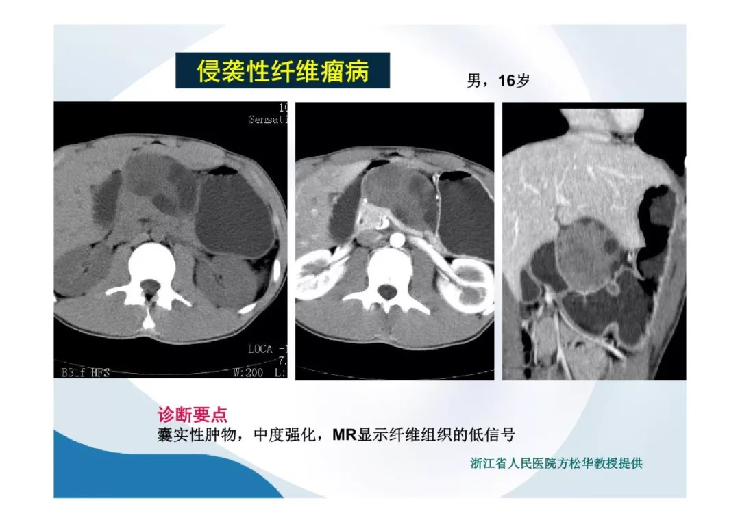 【PPT】胰腺非常见肿瘤影像学检查与诊断思路