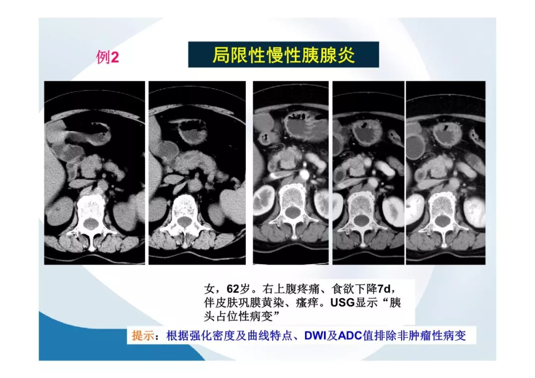 【PPT】胰腺非常见肿瘤影像学检查与诊断思路