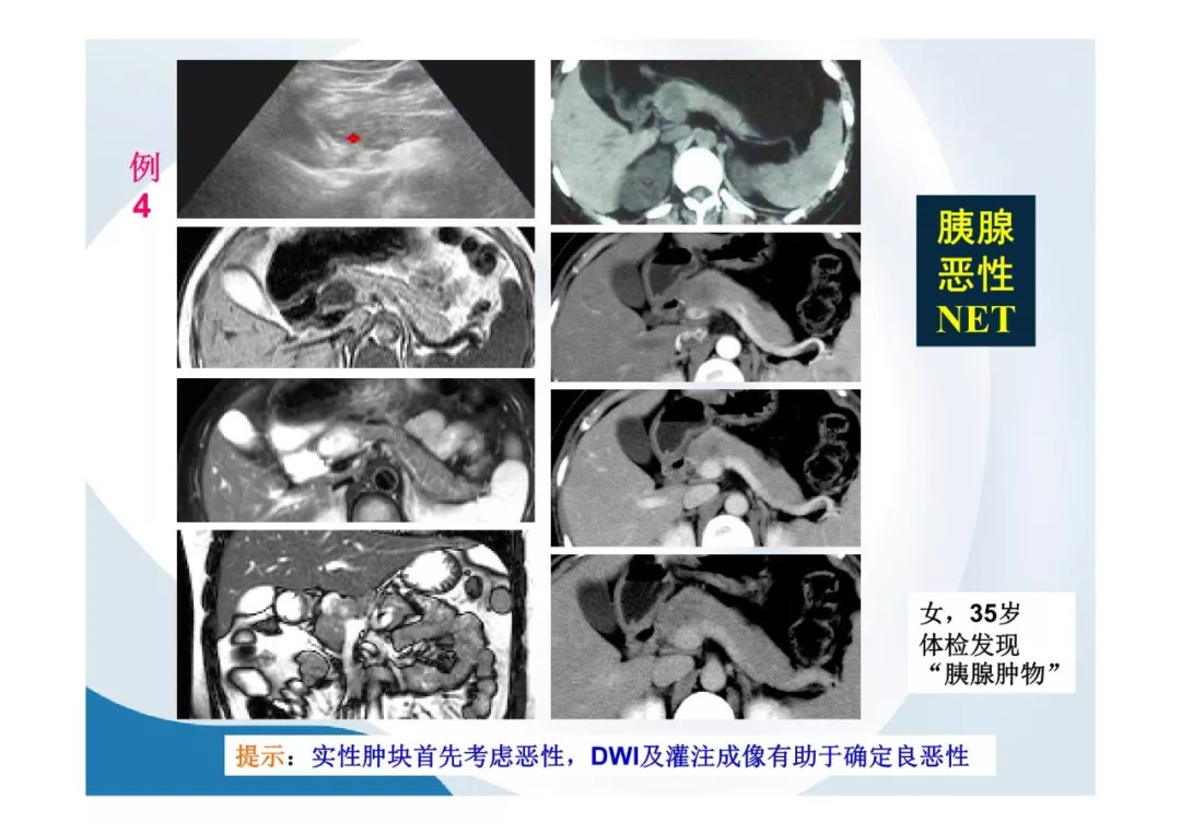 【PPT】胰腺非常见肿瘤影像学检查与诊断思路