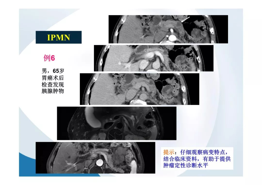 【PPT】胰腺非常见肿瘤影像学检查与诊断思路