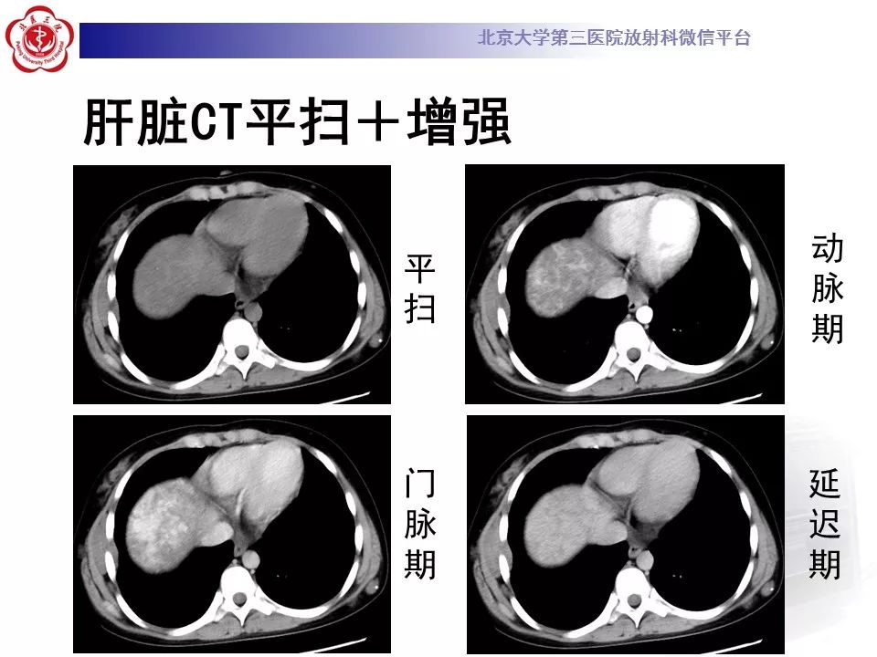 【病例】蓝色橡皮大疱样痣综合征1例CT及MR