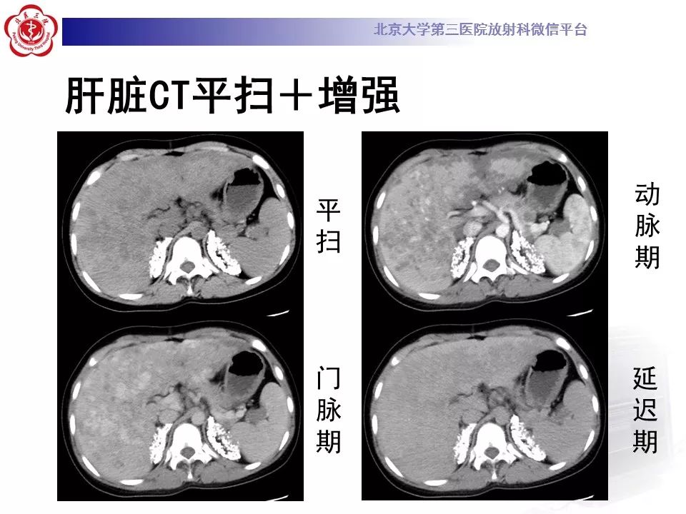 【病例】蓝色橡皮大疱样痣综合征1例CT及MR