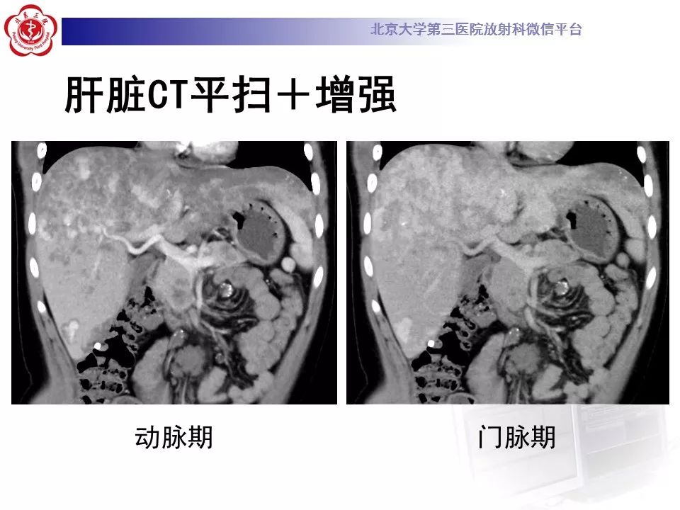 【病例】蓝色橡皮大疱样痣综合征1例CT及MR