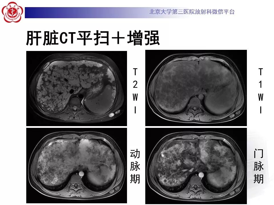 【病例】蓝色橡皮大疱样痣综合征1例CT及MR