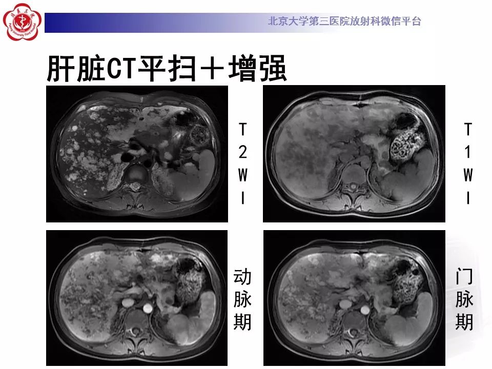 【病例】蓝色橡皮大疱样痣综合征1例CT及MR