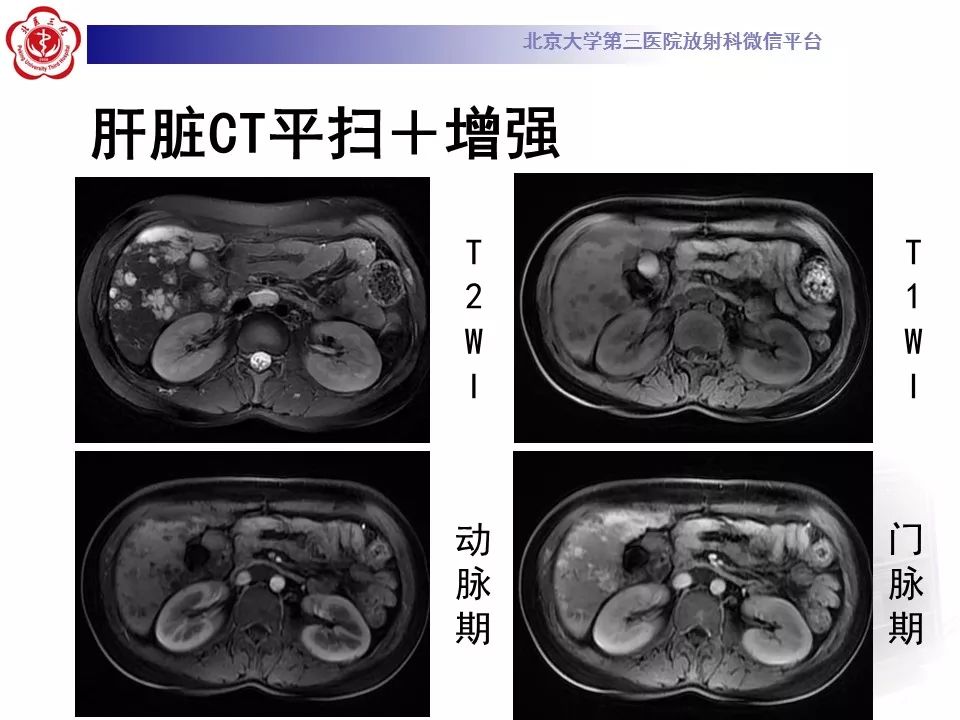 【病例】蓝色橡皮大疱样痣综合征1例CT及MR